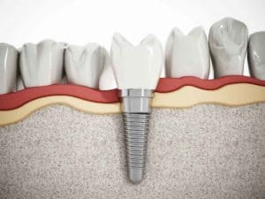 RLJ Dental dental implants