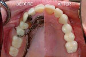 Read more about the article Implant bridges are the closest thing to having your own teeth